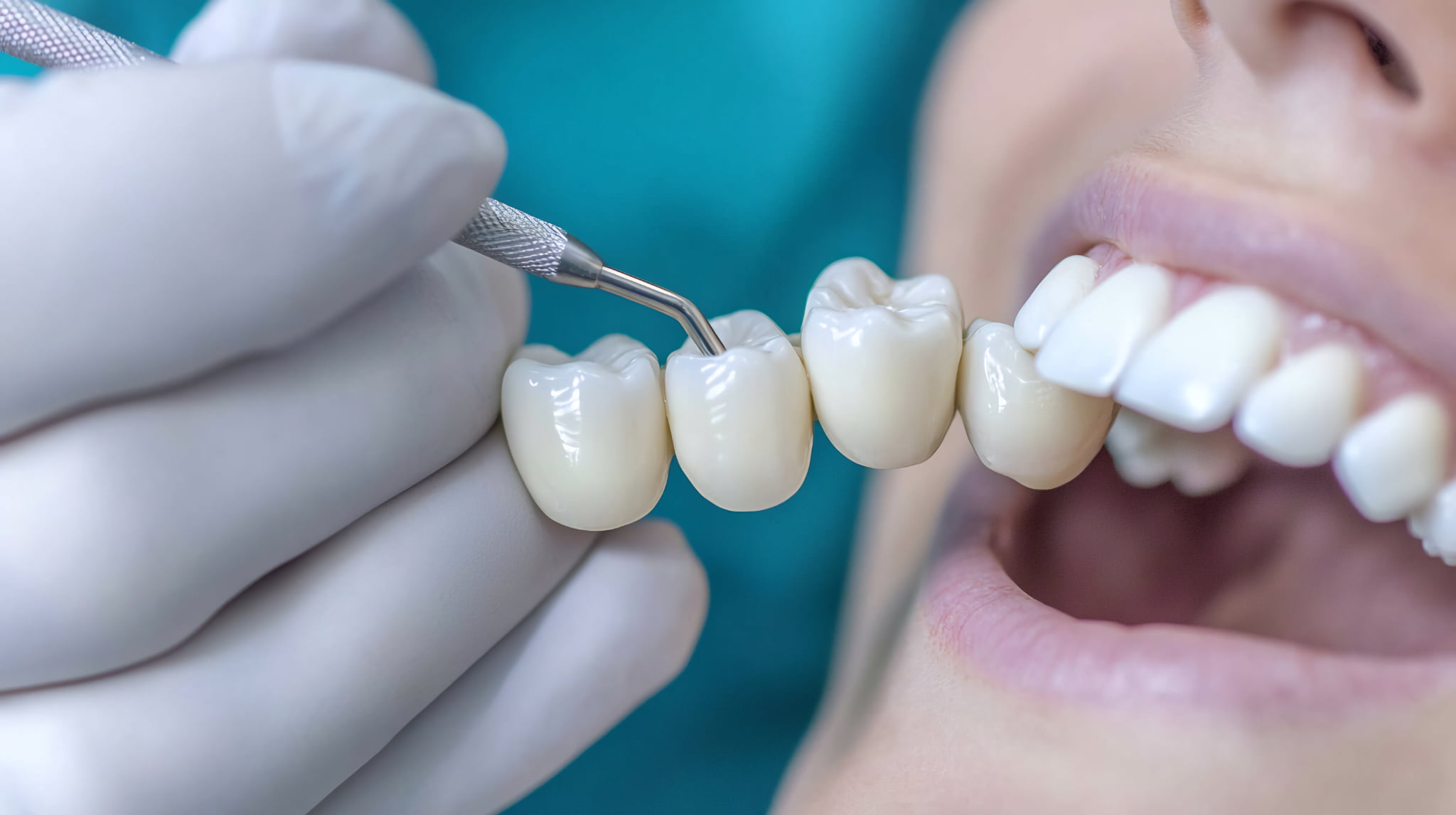 奥歯のインプラント治療ができないため代替案のブリッジで治療する様子