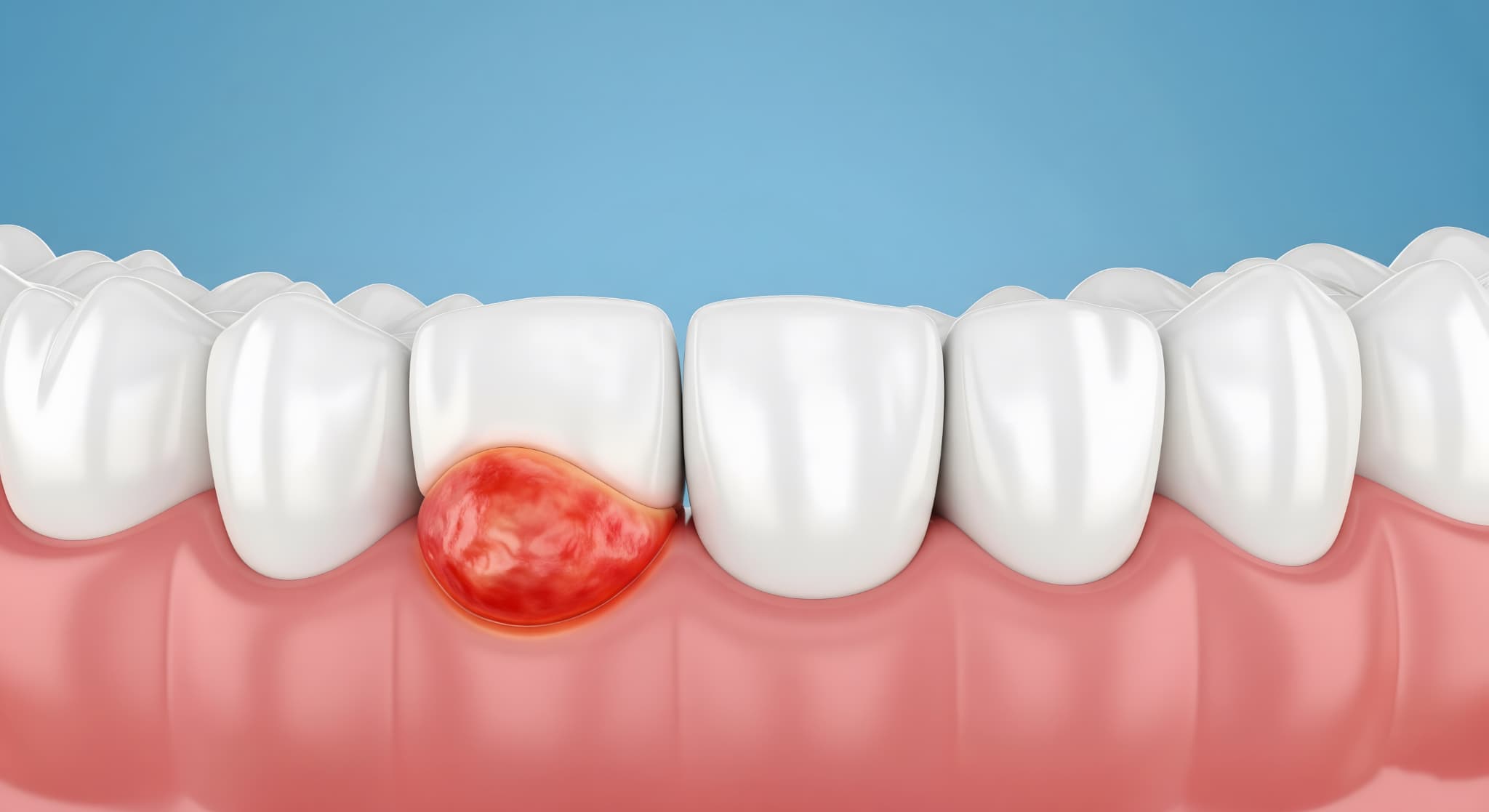 歯周病で出血した歯茎